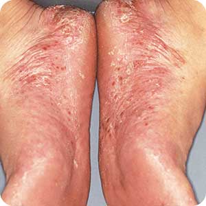 掌蹠膿疱症(しょうせきのうほうしょう)